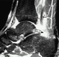 MRI of Ankle Joint