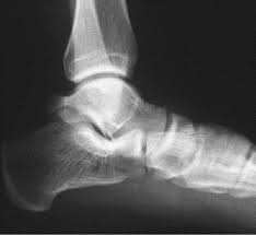 x-ray of Ankle Joint