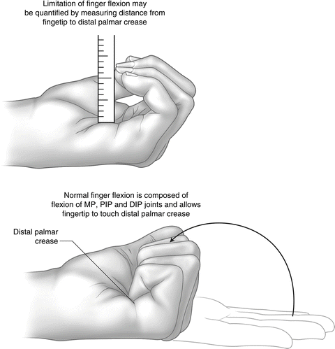 Composite finger flexion (CFF)