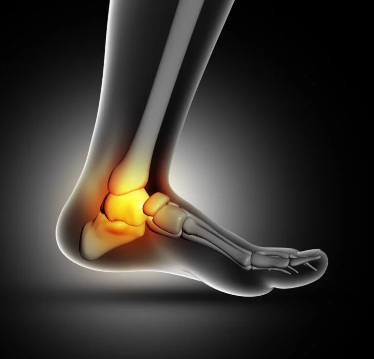 Ankle joint stiffness