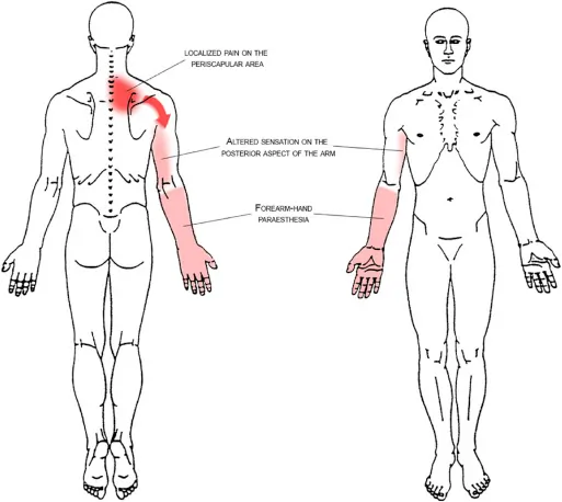T4 Syndrome
