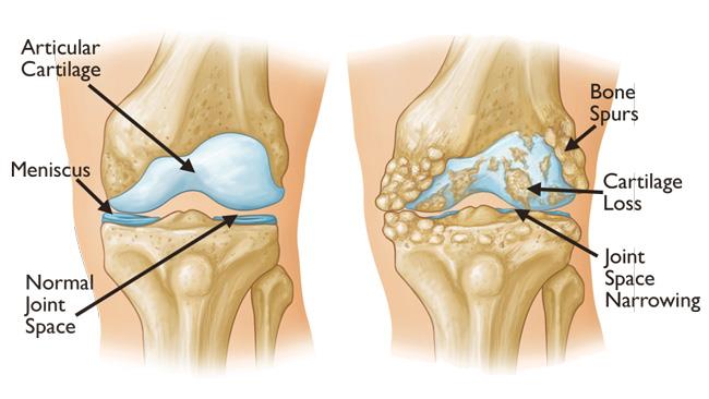 Knee Joint stiffness
