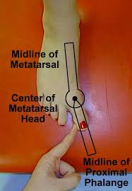 Metatarsophelengeal joint abduction