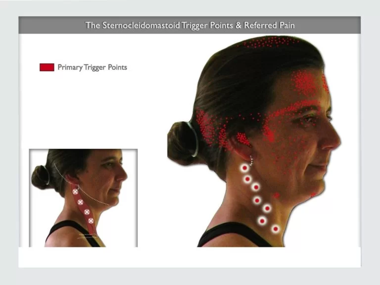 sternocleidomastoid muscle trigger points
