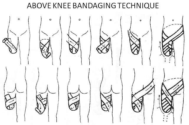 The above knee amputations Bandaging Technique