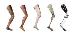 The Above Knee Amputations : Indication, Physiotherapy, Prosthesis