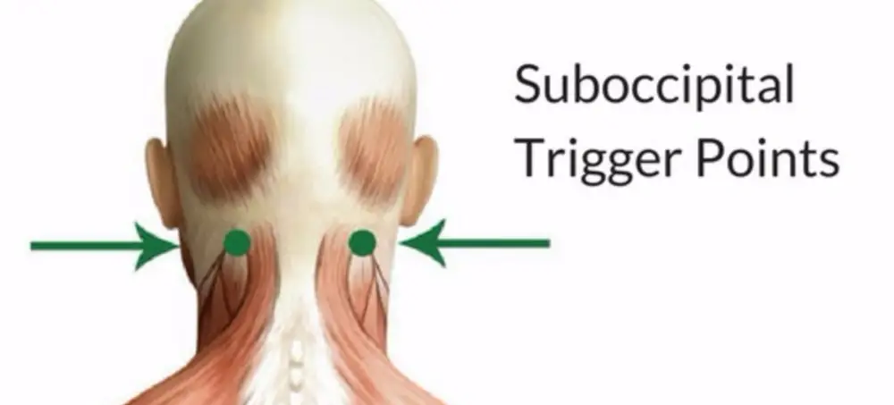 trigger points in the suboccipital muscle
