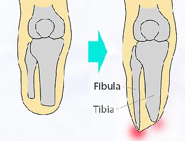 Fibula Overgrowth
