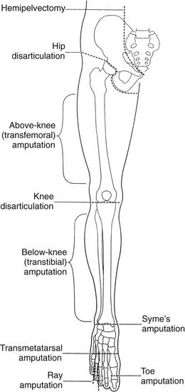 Lower limb Amputation level