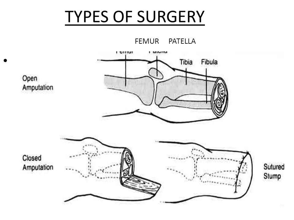 TYPES OF SURGERY FEMUR PATELLA AMPUTATION