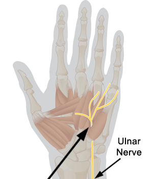 Ulnar tunnel syndrome : Cause, Symptom's , Treatment, Exercise