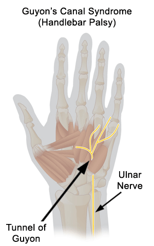 Ulnar tunnel syndrome : Cause, Symptom's , Treatment, Exercise