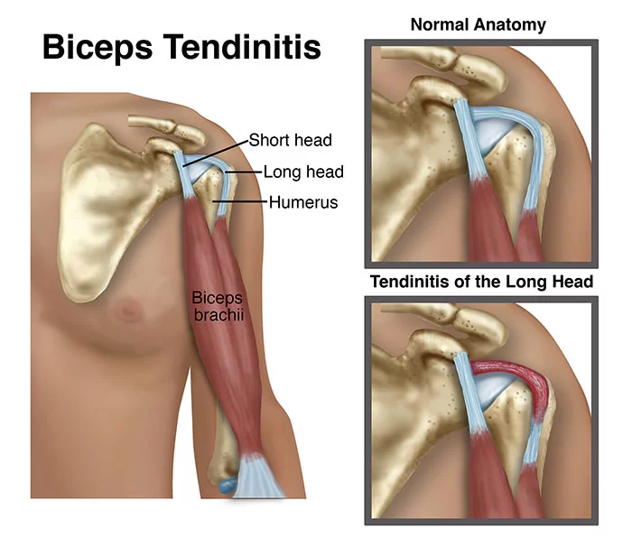 Biceps Tendinopathy Physiotherapy Treatment & Exercise