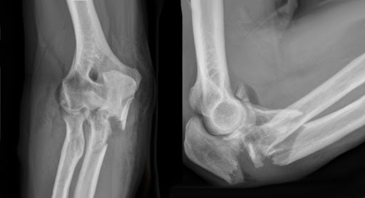 FRACTURE OF ELBOW