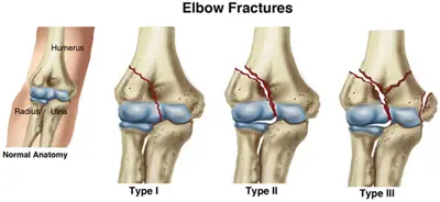 Fracture of the Elbow