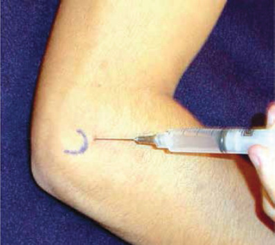 INJECTION FOR LATERAL EPICONDYLITIS