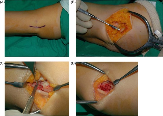 SURGICAL TREATMENT