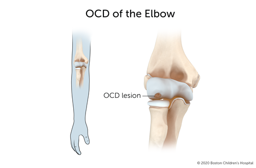 OCD OF THE ELBOW 