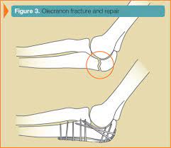 SURGICAL TREATMENT OF FRACTURE
