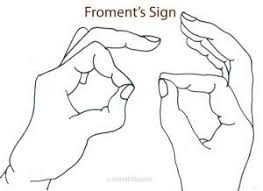 Froment’s Sign