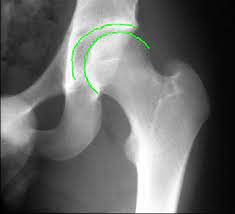 Hip Joint Arthritis X-Ray