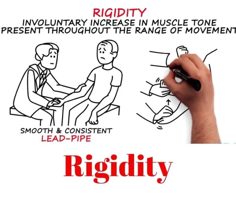Rigidity & Physiotherapy Treatment