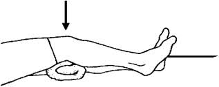 Static Quadriceps exercise (SQE)