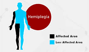 Hemiplegia left side : Physiotherapy Treatment and Exercise :