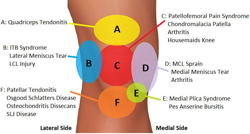Differential Diagnosis for the iliotibial band (IT band) syndrome 