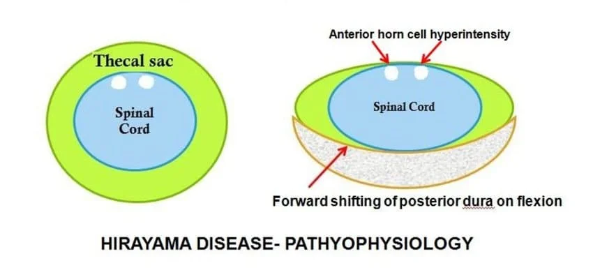 Hirayama Disease Pathophysiology