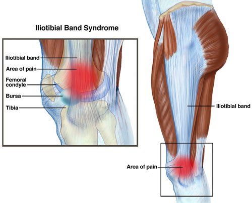 Iliotibial band syndrome (ITBS) : Physiotherapy Treatment, Exercise