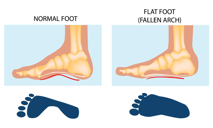FLAT FOOT - RISK FACTOR