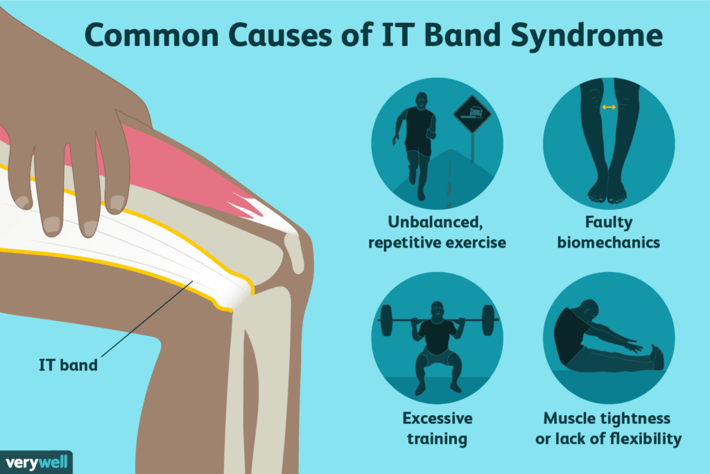 Physiotherapy for IT Band Syndrome