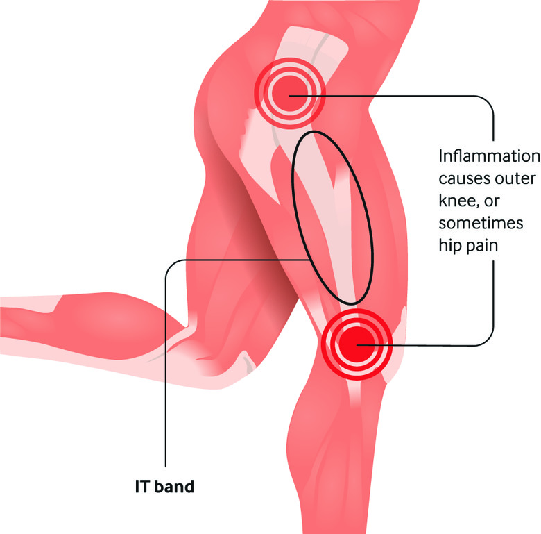 the iliotibial band (IT band) syndrome symptoms and signs