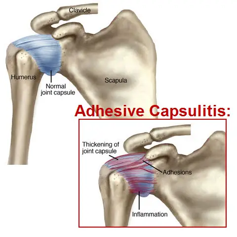 Adhesive Capsulitis of Shoulder: Physical Therapy Treatment & Exercise