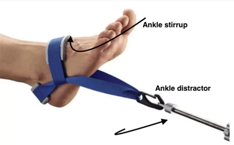 Ankle Traction: Uses, Purpose, Contraindications, How to take traction at home?