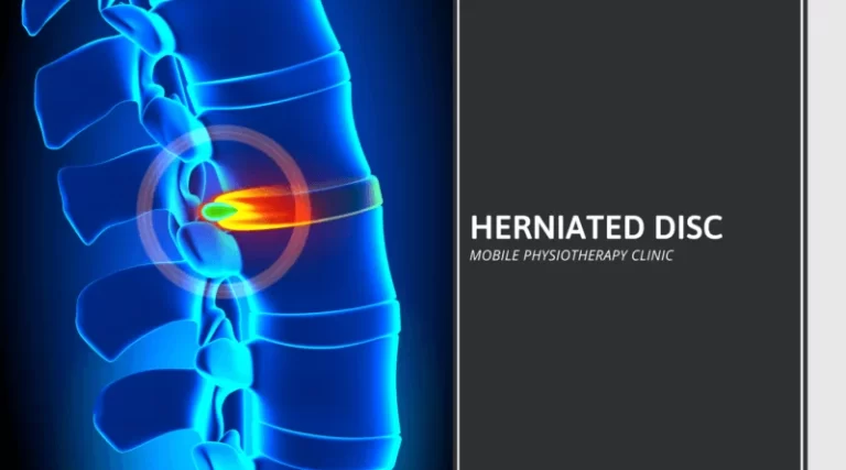 How to treat Disc herniation? Physiotherapy Treatment & Exercise