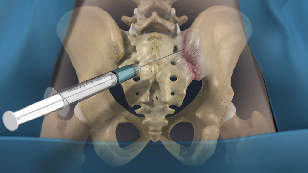 Sacroiliac joint injection :