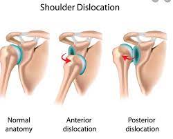 Shoulder dislocations