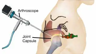 Surgery of the adhesive capsulitis