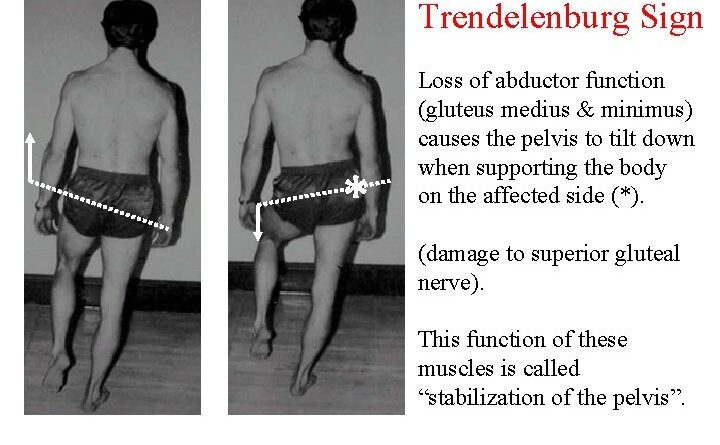 Trendelenburg S Sign Cause How To Do Test Limitation Indication