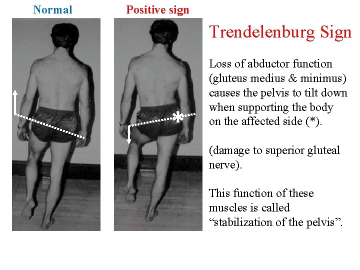 Trendelenburg s Sign Cause How To Do Test Limitation Trendelenburg s Sign Cause How To Do Test Limitation