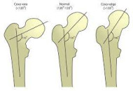 NECK–SHAFT ANGLES OF THE FEMUR IN ADULTS