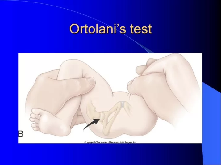 Ortolani’s Sign for Hip Pathology