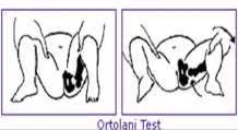 Ortolani’s test