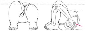 Special test for the hip pathology in pediatric: - Mobile Physiotherapy ...