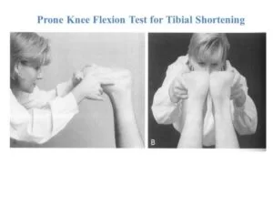 PRONE KNEE FLEXION TEST FOR TIBIAL SHORTING