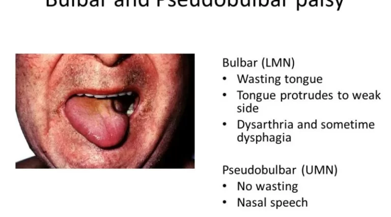 Pseudobulbar Palsy : Cause, Symptoms, Physiotherapy Treatment