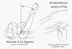 Craig's test of hip - Mobile Physiotherapy Clinic