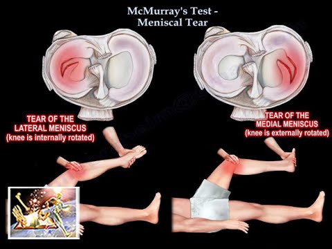 McMurray test